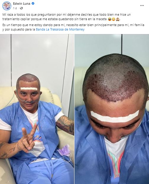 Edwin Luna se somete a tratamiento capilar para injertarse cabello