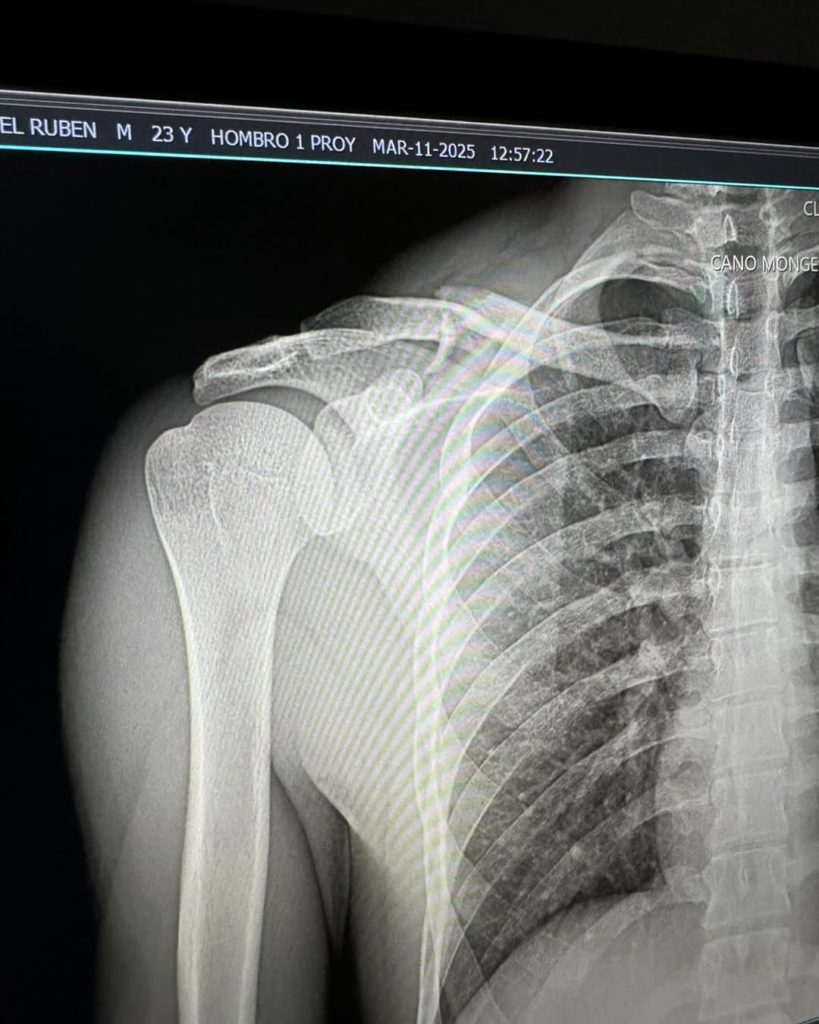 Natanael Cano sufre fractura de clavícula tras nuevo accidente en motocross